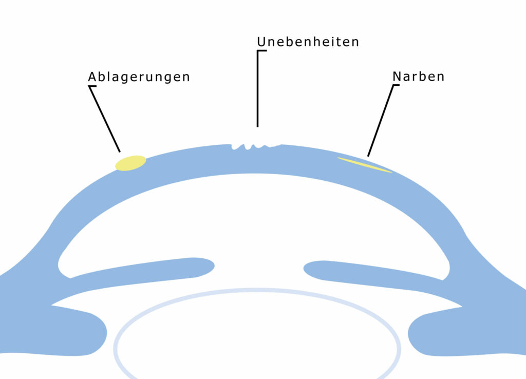 Stilisierte Infografik des Auges, die mögliche Hornhautprobleme aufzeigt