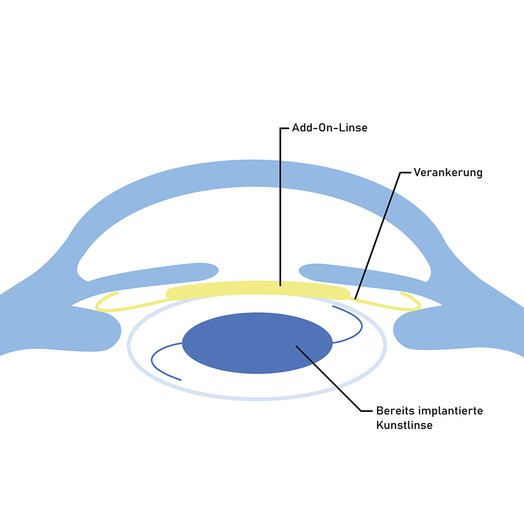 Infografik mit der Darstellung einer implantierten Add-On-Linse